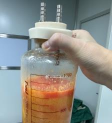东明水动力吸脂手术要做多久？